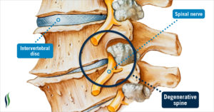 arthritis of the spine, degenerative spine diagnosis, Sciatica, Foraminal stenosis, Bone spurs, spinal stenosis, Degenerative scoliosis, Spondylolisthesis, Bulging discs, herniated discs, Spinal osteoarthritis, degenerative spine, degenerative disc, pinched spinal nerve